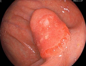 盲腸にIIa+IIc様病変を認める。
壁変形が強く、拡大内視鏡所見も
加味して、腹腔鏡手術が第一選択となる症例である。