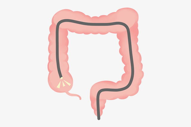 大腸カメラ検査は